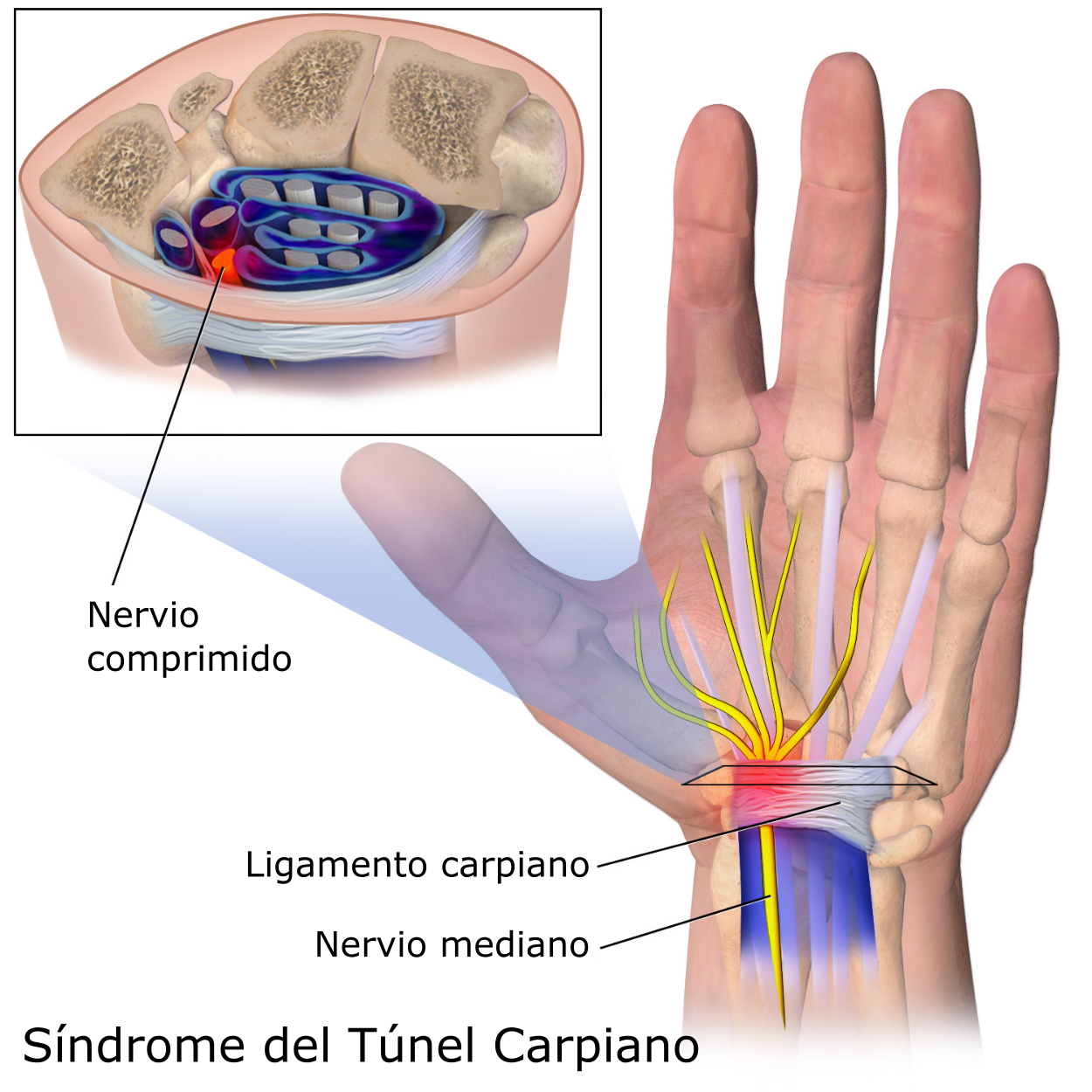 S Ndrome Del T Nel Carpiano Biox Fisioterapia